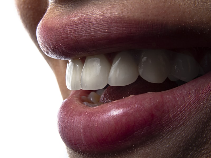 Porcelain veneer smile makeover — 8 upper veneers for a natural, balanced smile